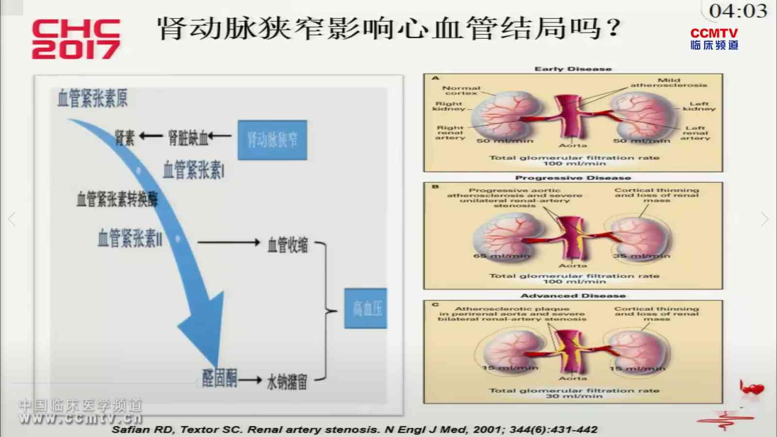 张皓:下肢DVT的腔内治疗