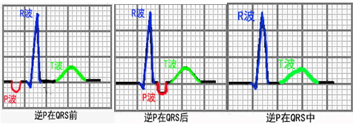 p波是心房除极过程的电活动表现,正常p波起源于窦房结,而逆行p波是起