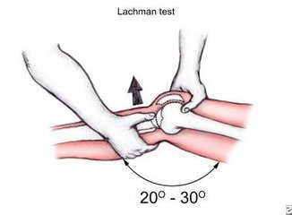 拉赫曼试验（Lachman Test）.jpg